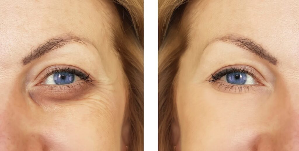 The Surprising Reason for Your Eye Bags—and How to Fix It 