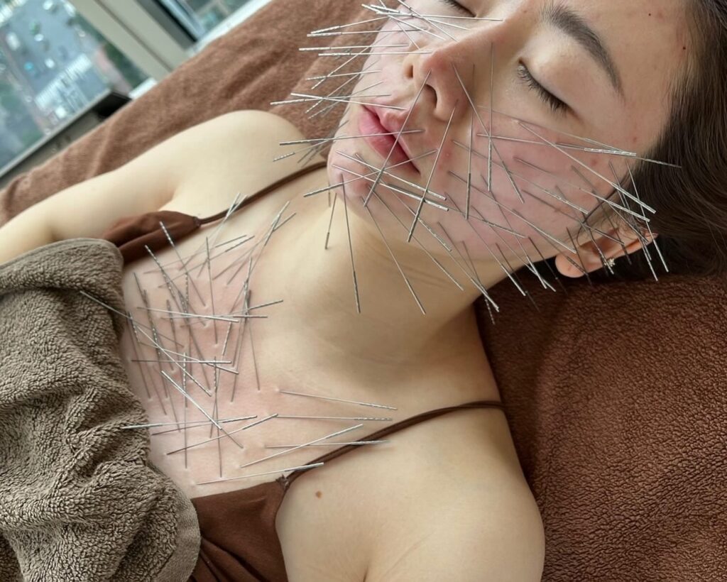 Acupuncture Craze Turns You into a Human Porcupine—But People Love It