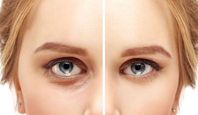 Blepharoplasty – Eyelid Surgery For A Fresher, Younger Look