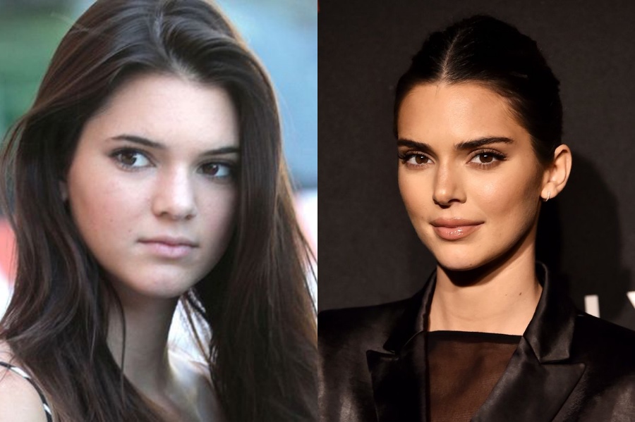 Kendall Jenner’s Plastic Surgery | 7 Juicy Facts About Kendall Jenner | HerBeauty