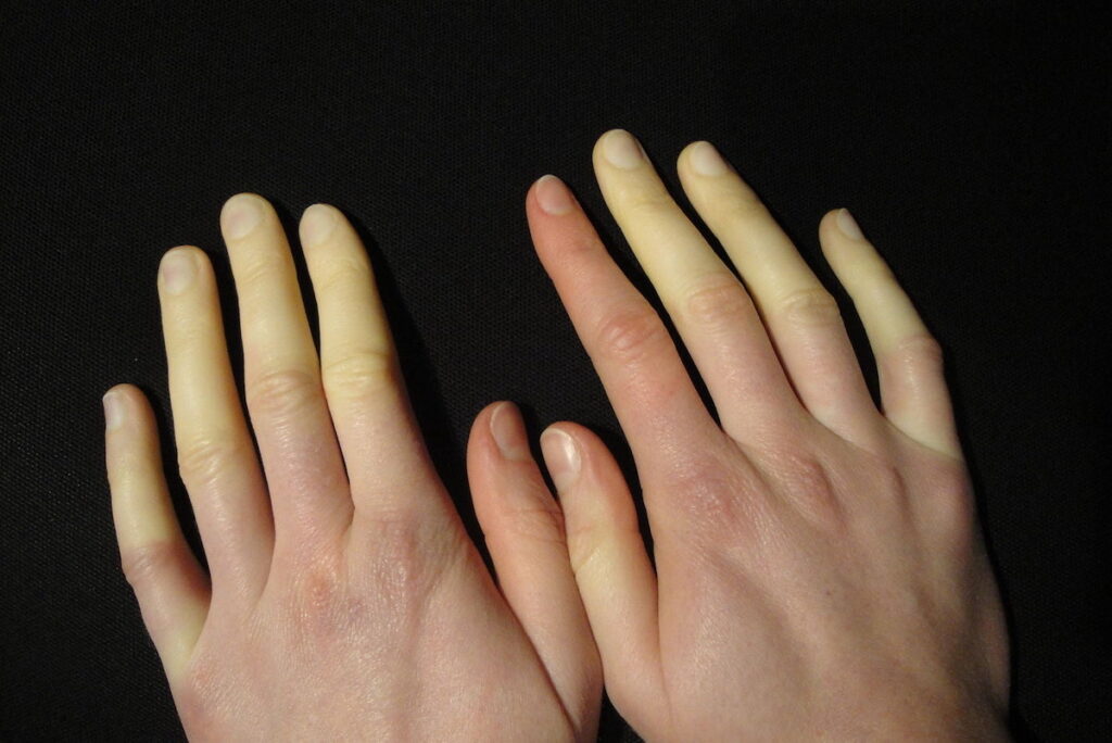 Why Are Your Hands Always Cold — The Shocking Disorder Known As Raynauds