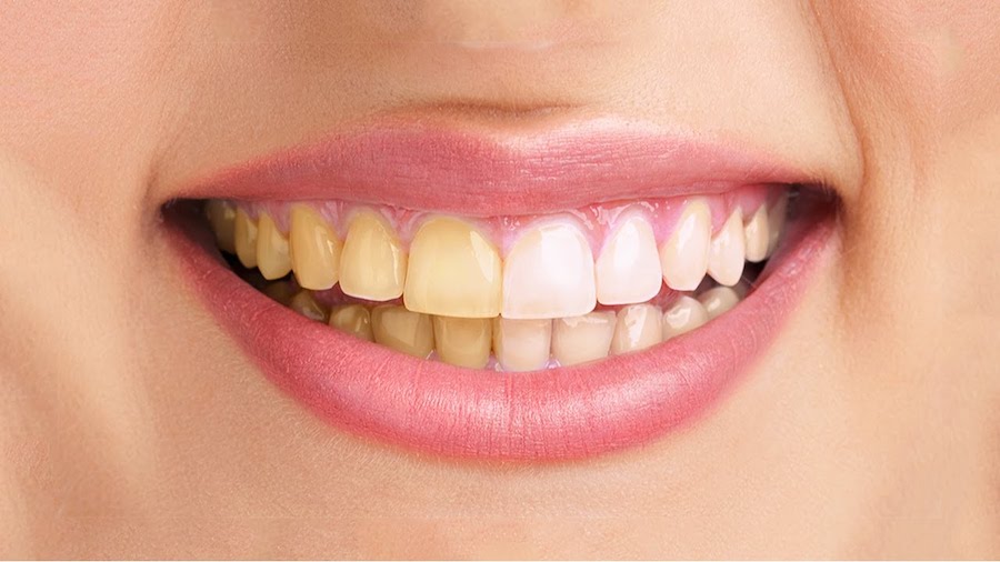 5 Things Everyone Should Know About Teeth Whitening