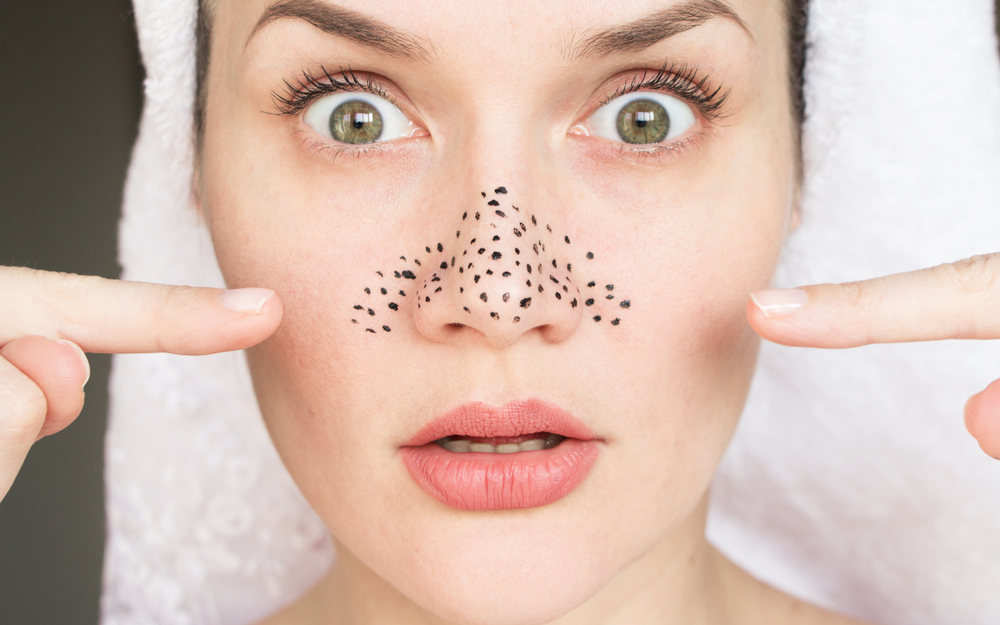 How To Get Rid Of Blackheads