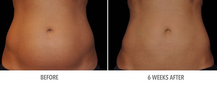 Results are not immediate | Coolsculpting Dos And Don'ts | Her Beauty