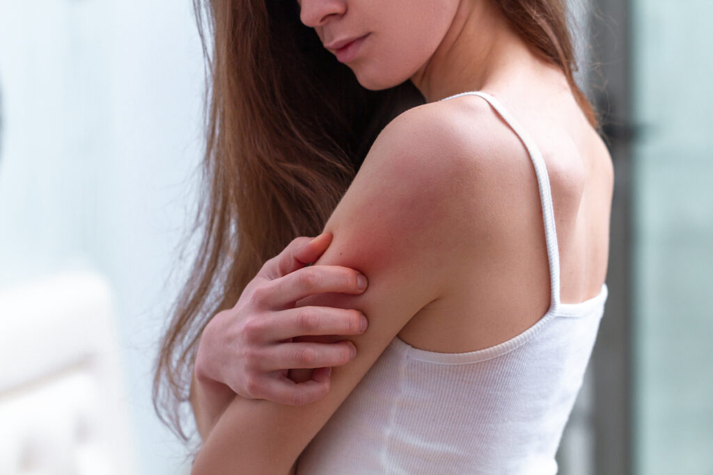 11 Ways to Treat Psoriasis at Home
