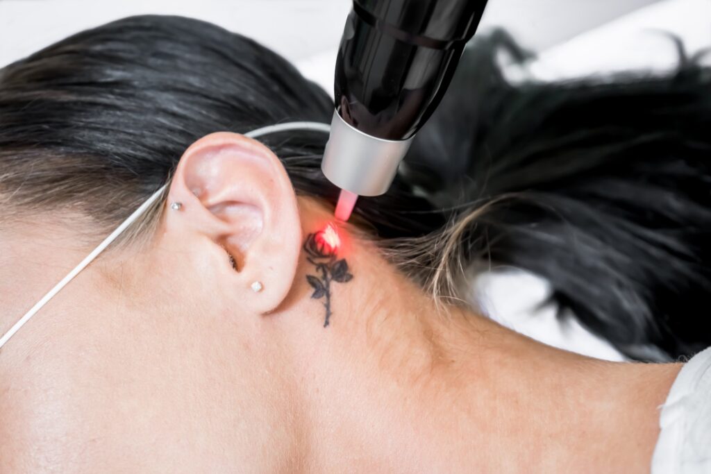 The Most Asked Questions About Laser Tattoo Removal